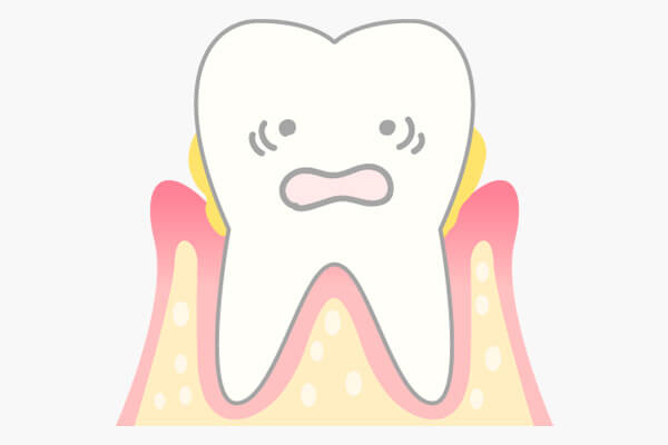 歯周病は自覚症状に乏しい病気です